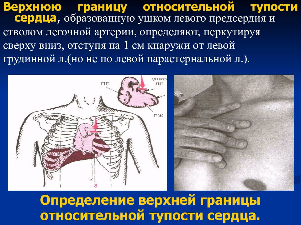 Границы абсолютной тупости сердца