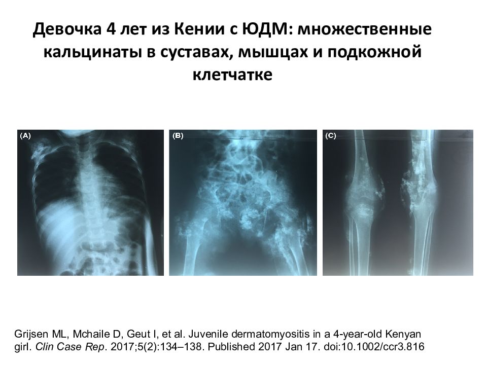 Системные заболевания соединительной ткани у детей презентация