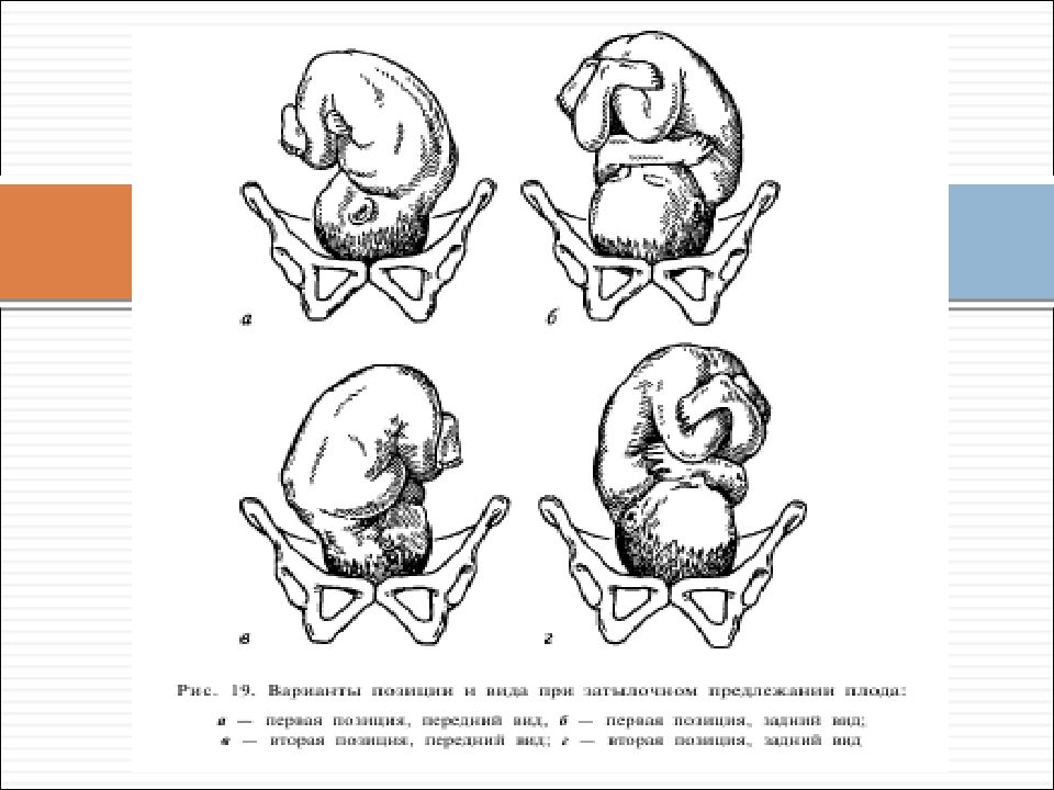 Биомеханизм родов при заднем виде затылочного предлежания презентация
