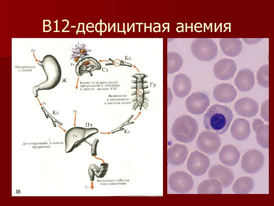 Клиническая картина в12 дефицитной анемии