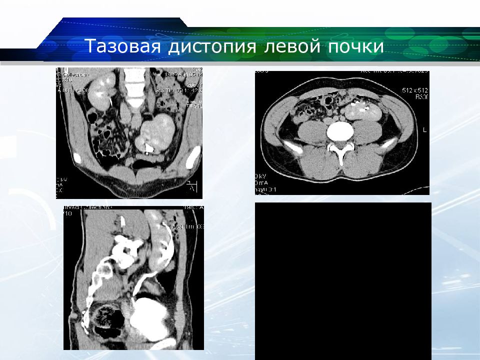 Дистопия почки. Тазовая дистопия почки кт. Тазовая дистопия почки рентген. Аномалия развития почек кт.