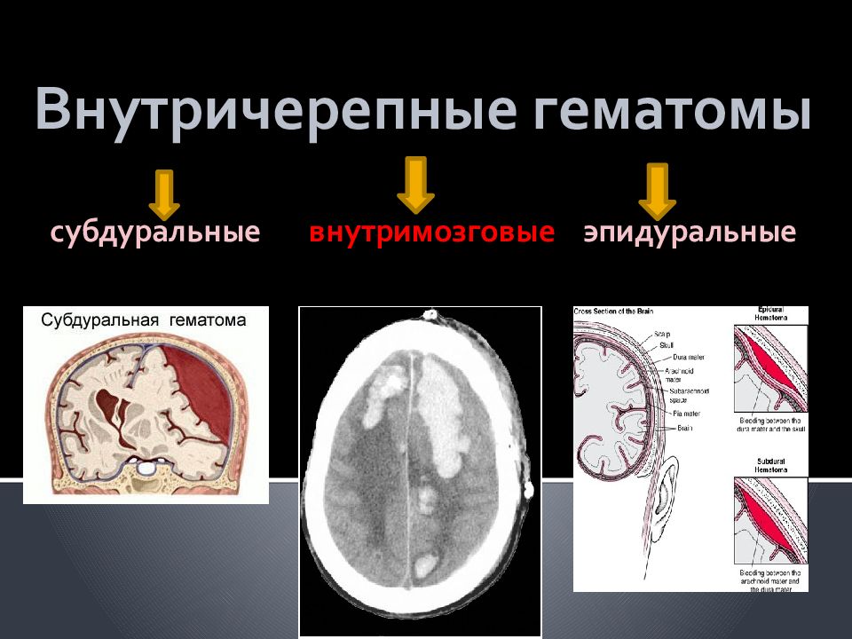 Гематома в стадии организации. Субдуральная гематома головного мозга диагностика. Эпидуральная субдуральная и внутримозговая гематома. Внутричерепная гематома. Внутричерепная субдуральная гематома.