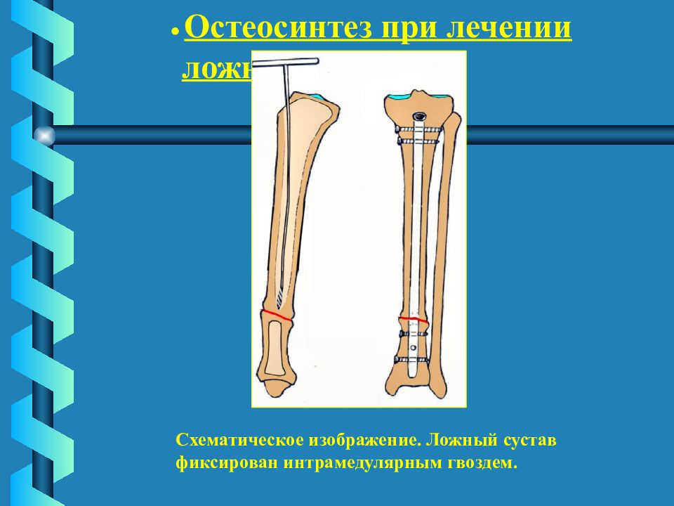 Ложный сустав рисунок