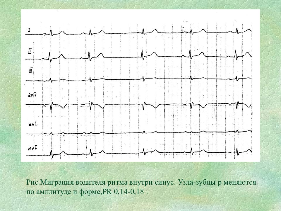 Миграция водителя ритма. Миграция предсердного водителя ритма ЭКГ. ЭКГ при миграции водителя ритма. Признаки миграции водителя ритма на ЭКГ. Миграция водителя ритма на ЭКГ У подростка.