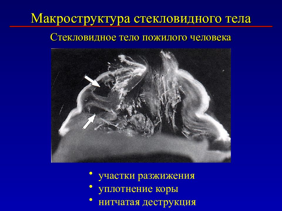 Форум деструкции стекловидного. Деструкция (искусство). Нитчатая деструкция стекловидного тела. Деструкция картинки. Деструкция картинки для презентации.