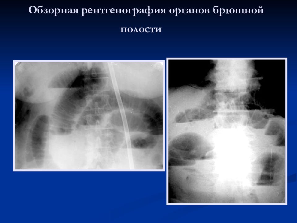 Обзорная рентгенография брюшной полости. Обзорная рентгенография органов брюшной полости. Обзорный рентген брюшной полости. Обзорная рентгенография ОБП. Обзорная рентгенограмма брюшной полости норма.