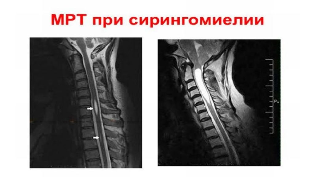 Сирингомиелия презентация по неврологии