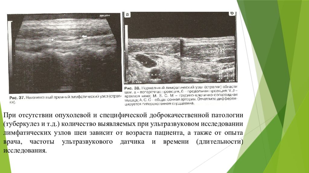 Узи лимфатических. Лимфоузлы щитовидной железы на УЗИ. Ультразвуковая картина лимфатических узлов в норме. УЗИ лимфатических узлов шеи. Нормальные лимфатические узлы на УЗИ.