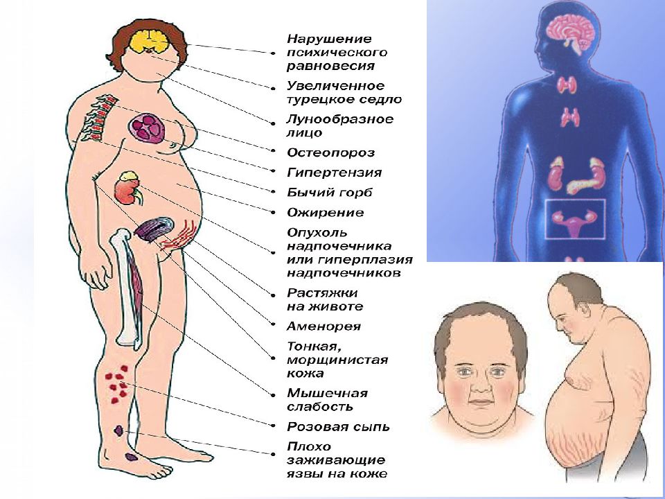 Нарушение гормонов. Опухоль гипофиза симптомы у женщин. Опухоль гипофиза надпочечников. Аденома гипофиза симптомы. Аденома гипофиза проявления.