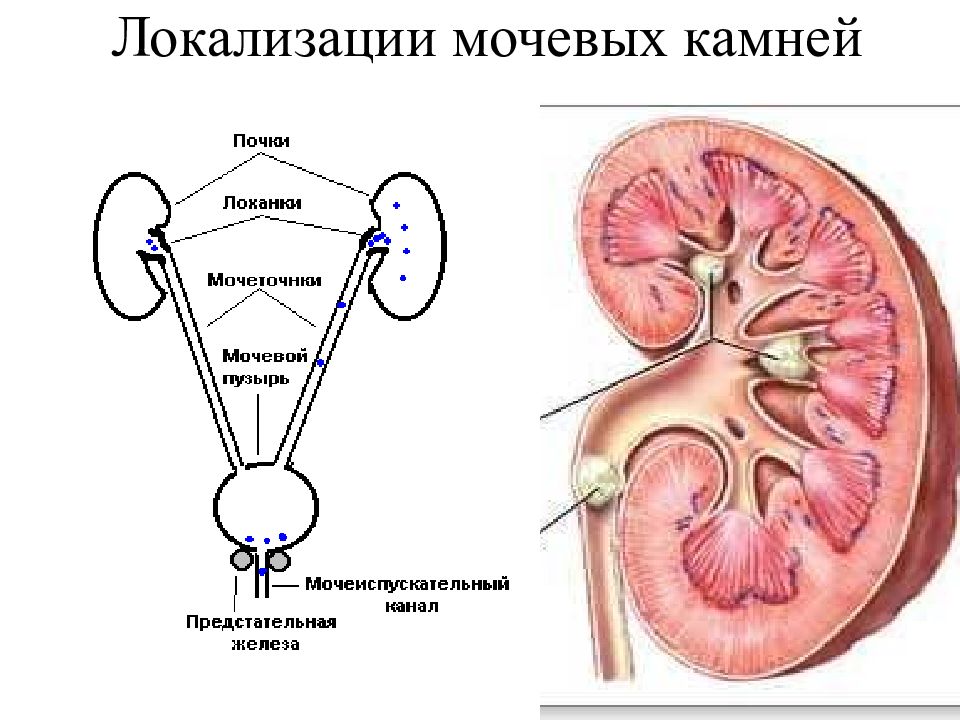 Мочевая пила. Локализация камней в почках. Локализация камней в мочевых путях. Локализация конкрементов почек. Конкременты в мочевыводящих путях.