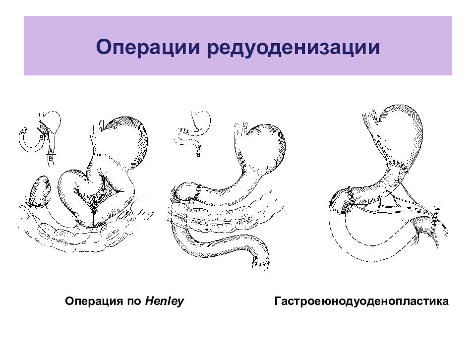 Презентация болезнь оперированного желудка