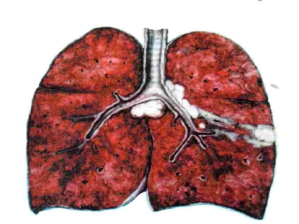 Первичный туберкулез картинки