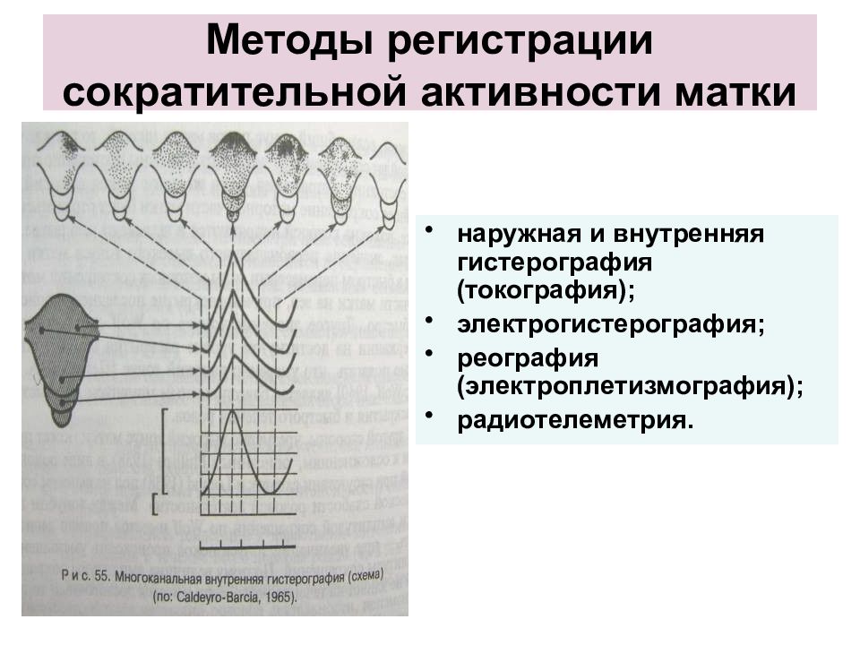 Метод регистрации. Методы регистрации сократительной деятельности матки. Методы регистрации родовой деятельности. Методы оценки сократительной деятельности матки. Наружная гистерография.