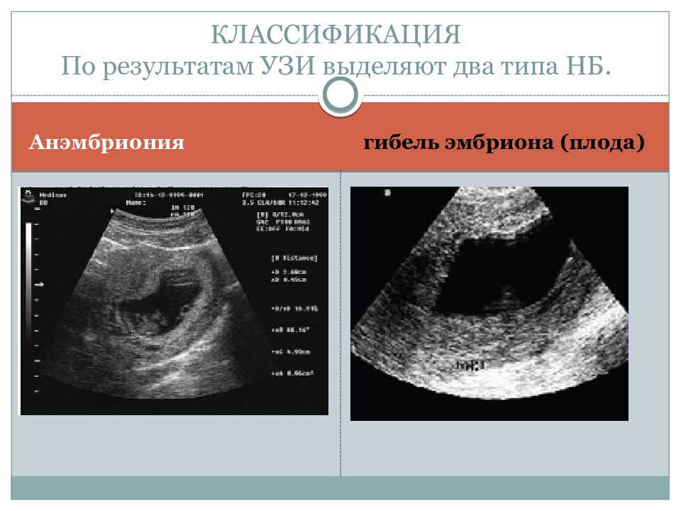 Ранний узи. Неразвивающаяся беременность УЗИ. УЗИ неразвивающейся беременности 6 недель. УЗИ при неразвивающейся беременности на ранних сроках. Замершая беременность по типу анэмбрионии.