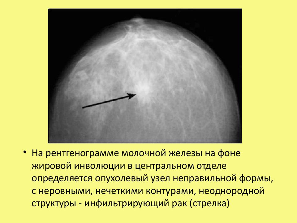 Что означает фиброзно жировая инволюция молочной железы