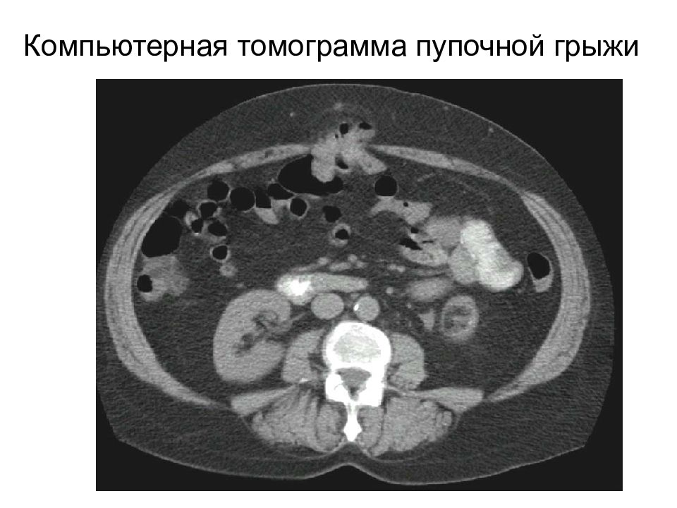 Мрт передней брюшной стенки. Кт картина пупочной грыжи. Грыжа на кт брюшной полости.
