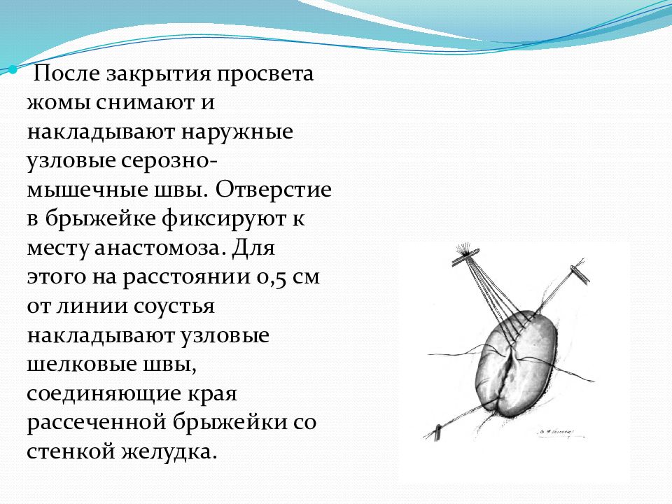 Шов мышцы. Узловой серозно мышечный шов. Несостоятельность гастроэнтероанастомоза.