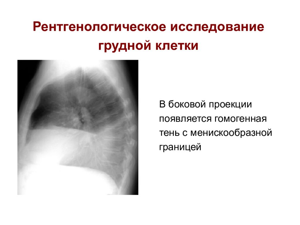 Исследование грудной клетки. Боковая проекция плеврального выпота. Рентген грудной клетки боковая проекция плеврит. Экссудативный плеврит боковая проекция. Правосторонний междолевой плеврит рентген боковая проекция.