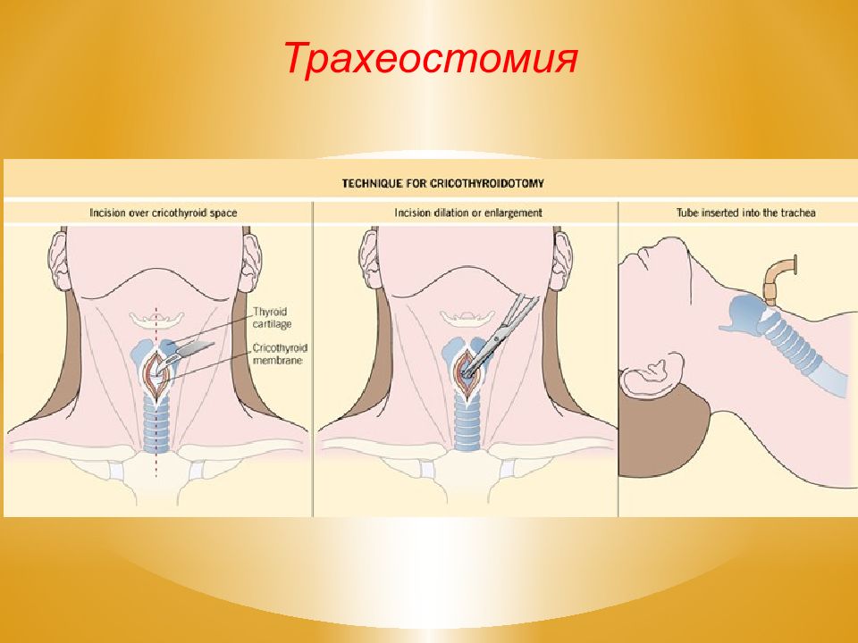 Трахеостомия. Трахеостомия Оперативная хирургия техника. Методика наложения трахеостомы.