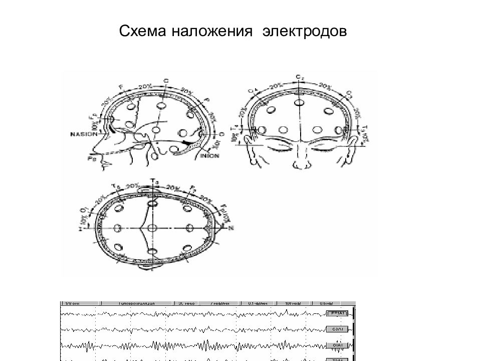 Схема 10 20 наложение электродов