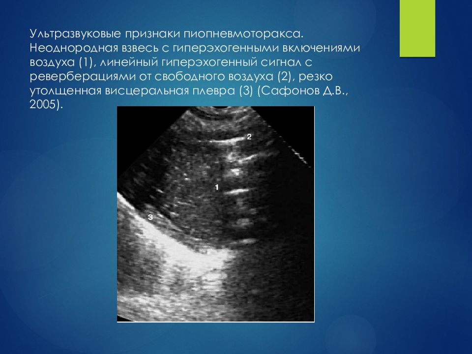 Синус гиперэхогенный. Гиперэхогенные линейные структуры. Гиперэхогенное линейное включение. Гиперэхогенные включения с эффектом реверберации. Мелкодисперсная гиперэхогенная взвесь.