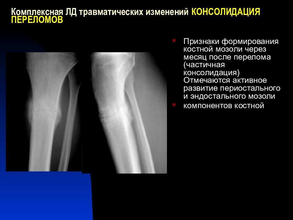 Что такое консолидация перелома. Консолидация перелома рентген. Консолидация большеберцовой кости. Консолидирующийся перелом на рентгене. Рентген костная мозоль пере.