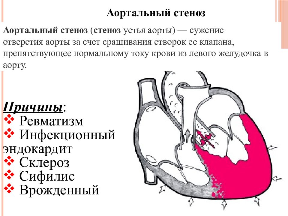 Сердечный стеноз. Порок сердца стеноз аортального клапана. Стеноз и недостаточность аортального клапана классификация. Стеноз клапана аорты сердца. Приобретенные пороки сердца схема гемодинамики.