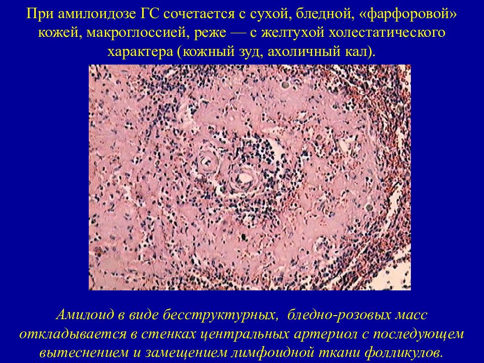 Амилоидоз печени презентация