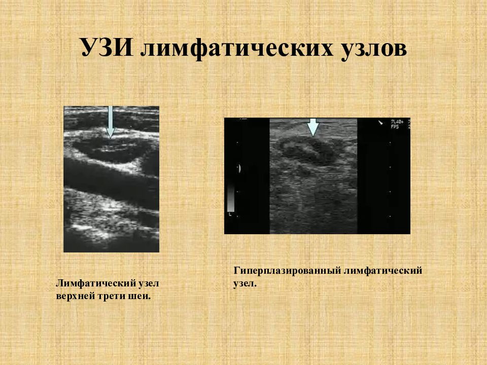 Узи лимфатических узлов паховые. Описание лимфатических узлов на УЗИ. УЗИ лимфатических узлов норма. УЗИ лимфатических узлов шеи.