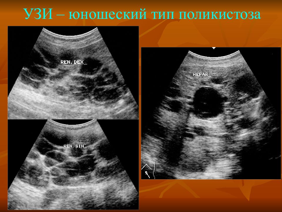 Поликистоз почек на узи. Эхограмма поликистоза почек. Поликистозная болезнь почек УЗИ. УЗИ почек снимок.