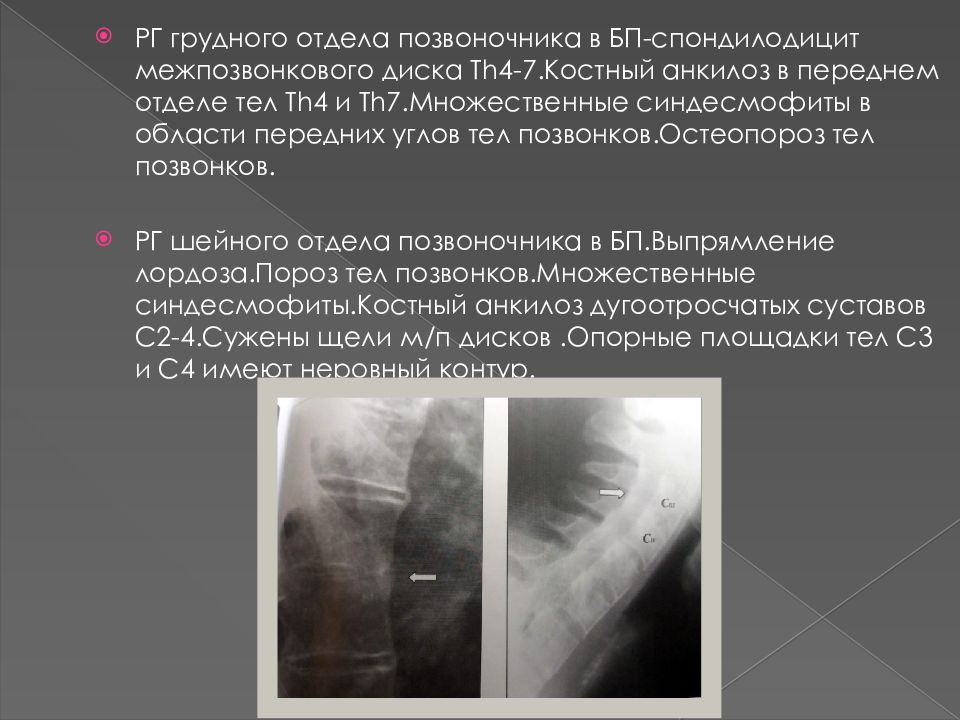 Анкилозирующий спондилит презентация