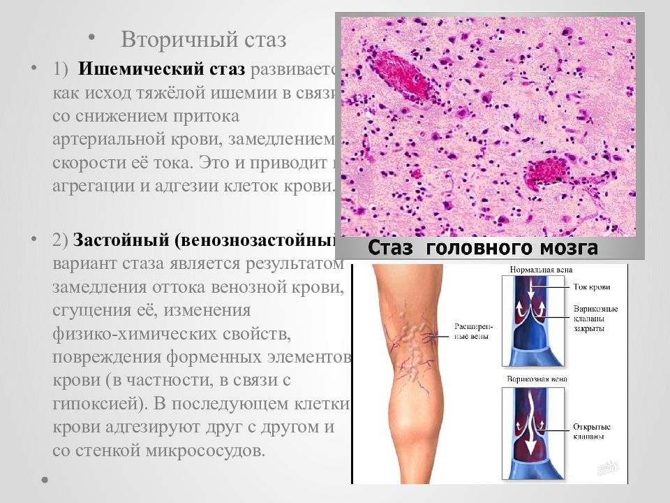 Осфр что это значит. Механизм развития стаза. Стаз патофизиология. Гипертрофия значение для организма.