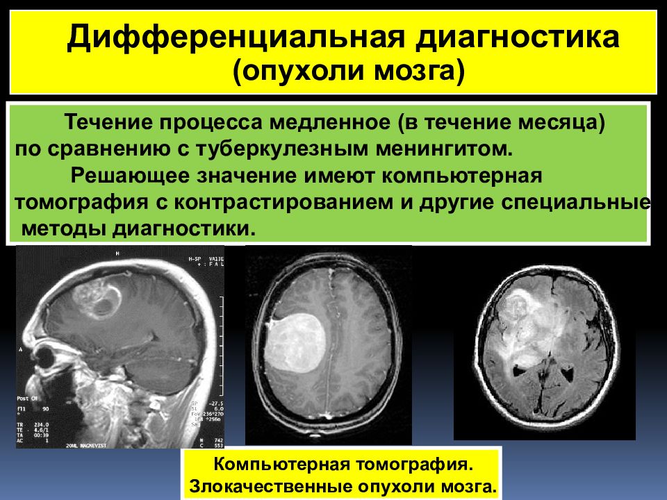 Туберкулезный менингит. Туберкулезный менингит кт. Отёк мозга диагностика кт. Кт снимки опухоли мозга. Инструментальные методы диагностики опухолей мозга.