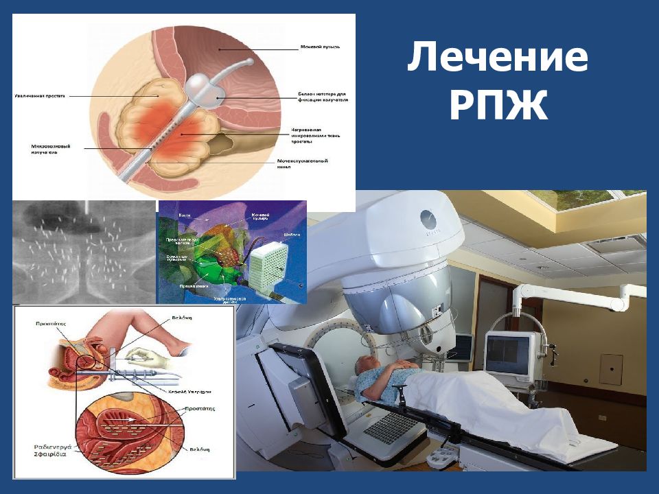 Терапия рака предстательной железы