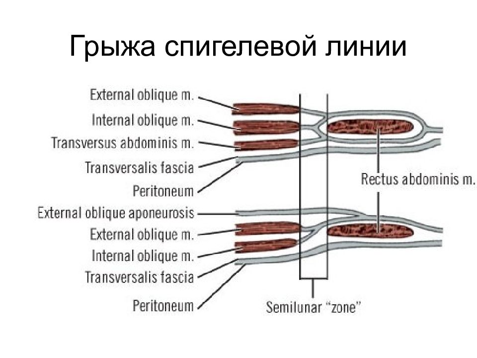 Грыжи спигелевой линии. Грыжи полулунной (спигелиевой) линии. Грыжа полулунной линии Спигеля. Грыжа спигелиевой линии живота анатомия.
