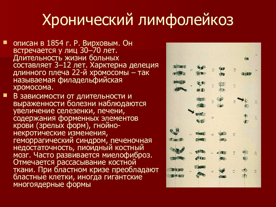 Хронический лимфолейкоз продолжительность