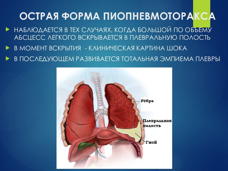 Острые легких. Пиопневмоторакс. Пиопневмоторакс классификация. Эмпиема плевры клиническая картина.