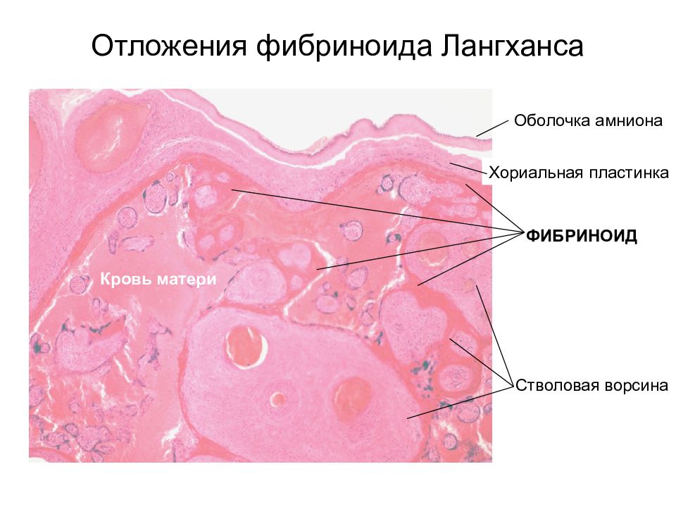 Плацента гистология. Материнская часть плаценты фибриноид Рора. Фибриноид плаценты гистология.