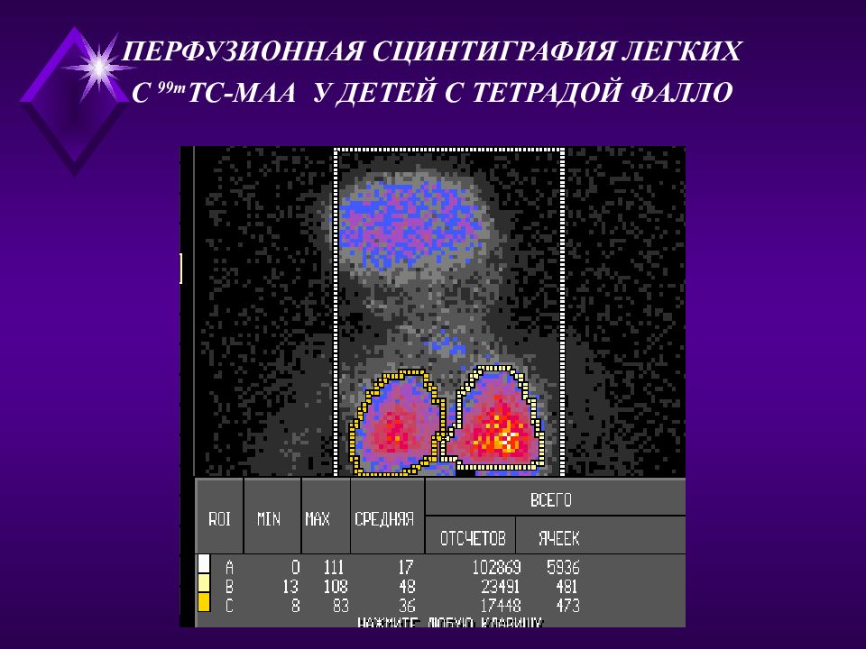 Сцинтиграфия это. Технеций-99m сцинтиграфия. Сцинтиграфия 99 технеций. Сцинтиграфия с тс99. Перфузионная сцинтиграфия легких.