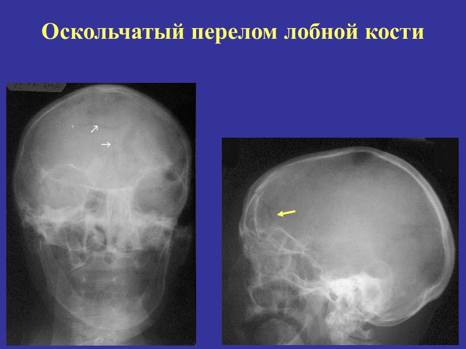 Оскольчатый перелом. Вдавленный перелом теменной кости кт. Трещина лобной кости черепа рентген. Перелом свода черепа рентген.