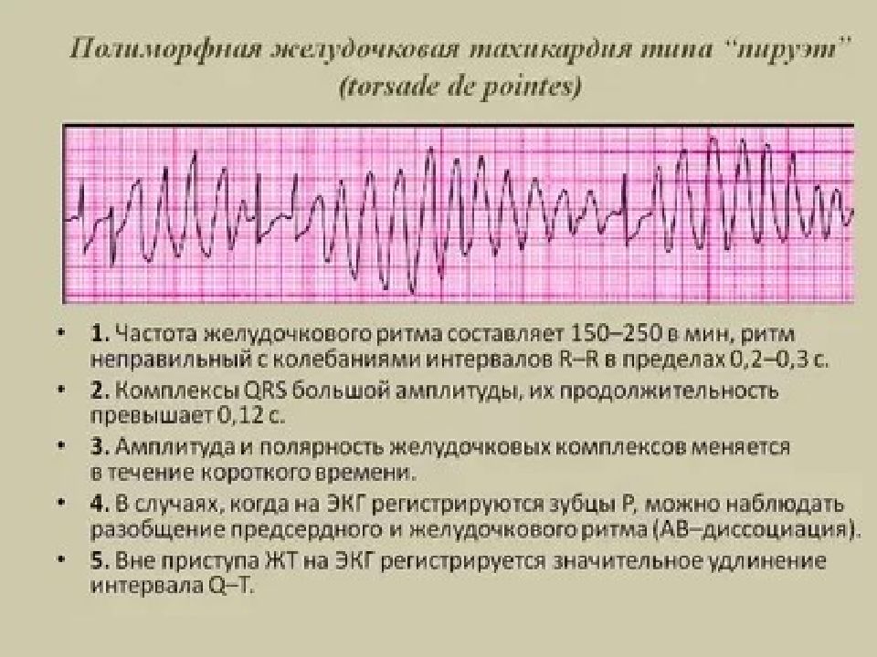 Желудочковая тахикардия картинки