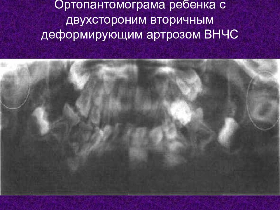 Тест рентгенологическая картина при артрозах внчс