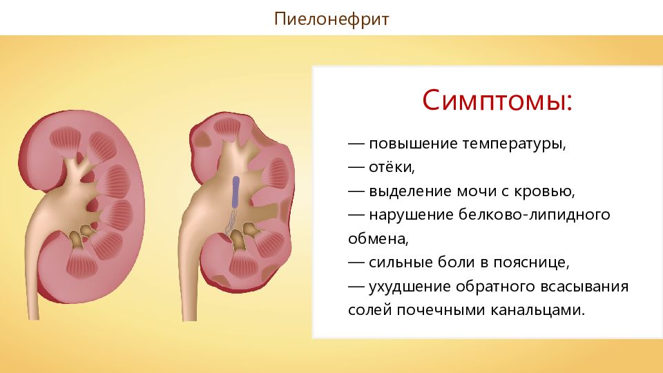 Презентация на тему пиелонефрит