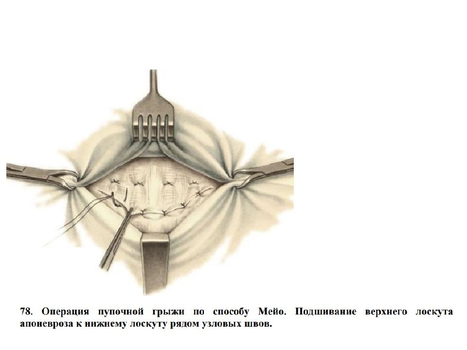 Пластика по сапежко