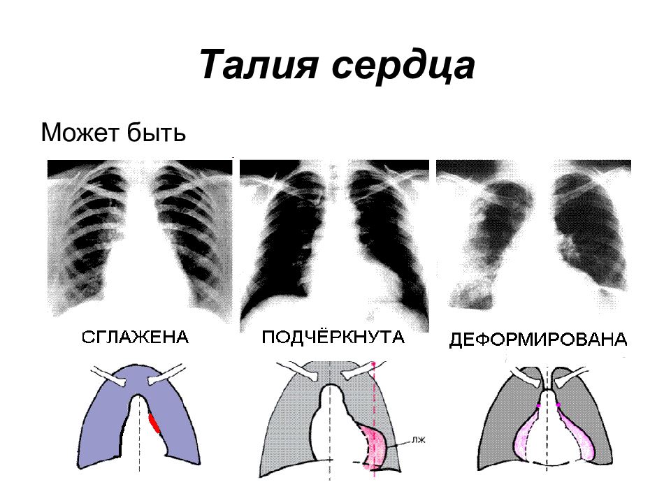 Талия сердца