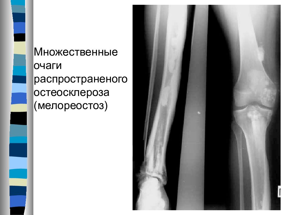 Остеосклеротические очаги в костях