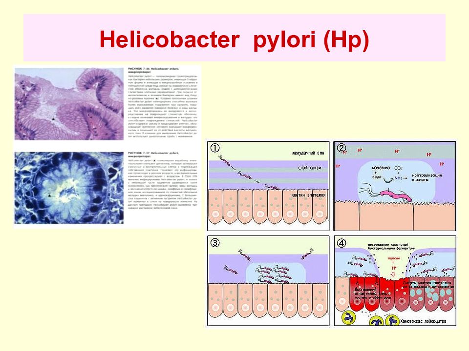 Хеликобактер пилори отзывы. Уреаза хеликобактер пилори. Уреаза Helicobacter pylori является. Helicobacter pylori iga что это значит.