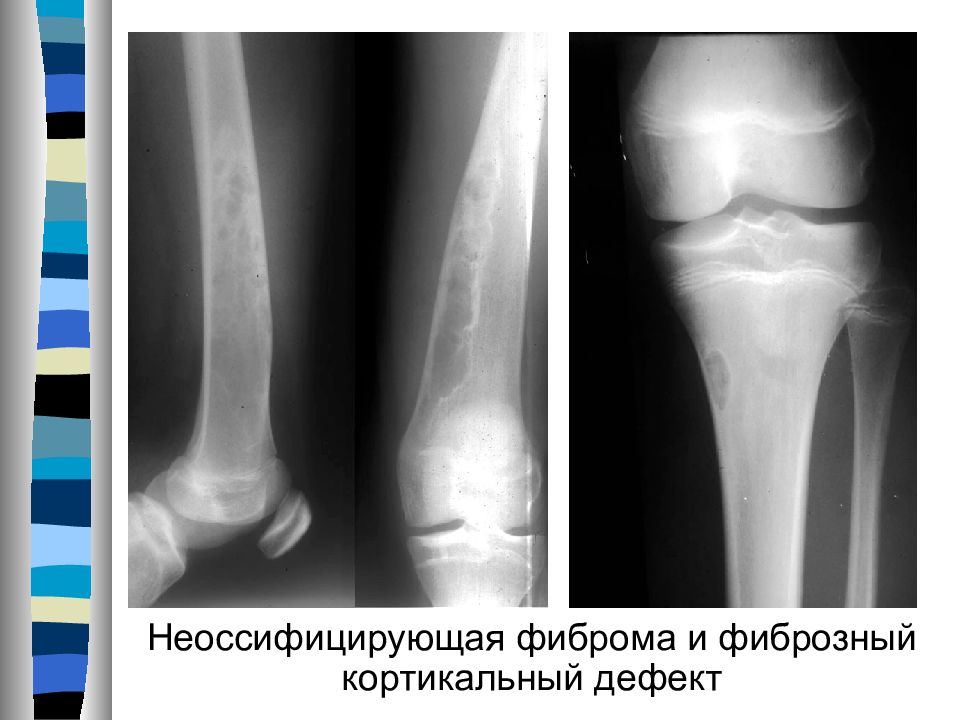 Неоссифицированная фиброма большеберцовой кости. Фиброзная дисплазия бедренной кости рентген. Неоссифицированная фиброма бедренной кости. Хондромиксоидная фиброма бедренной кости. Неоссифицирующая фиброма бедренной кости кт.