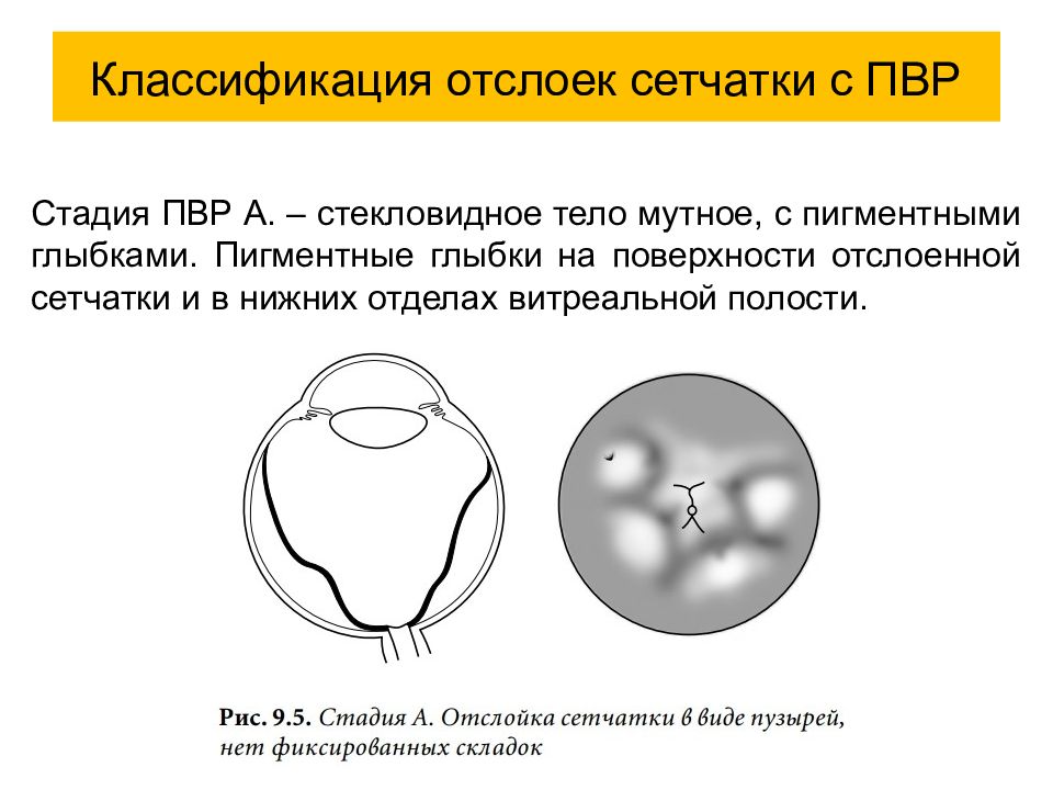 Презентация на тему отслойка сетчатки