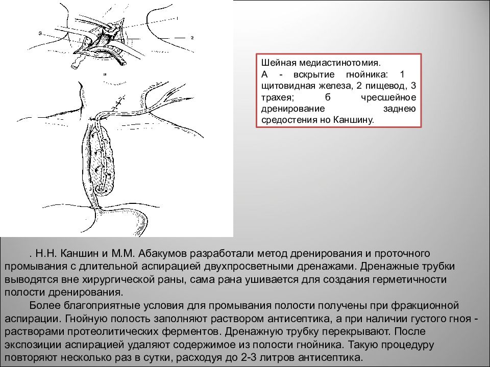 Воспаление клетчатки. Дренирование заднего медиастинита. Дренирование средостения Каншин. Дренирование средостения по Насилову.